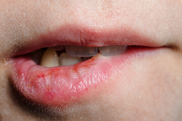 Macro lips with severely dry bleeding cracked or chapped lips. close up