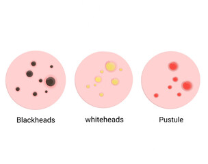 Types of Acne