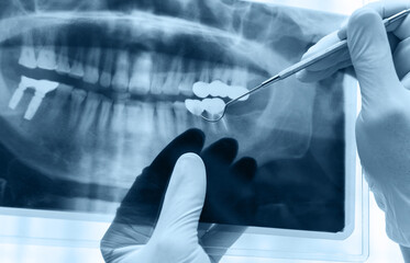 Dentist examining a panoramic dental x-ray