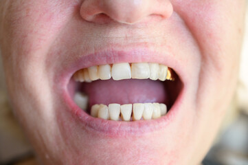 Close-up photo of natural looking teeth of a aged woman. - 637779078