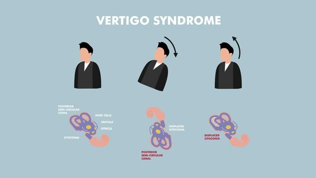 Vertigo Syndrome , BPPV 2d cartoon