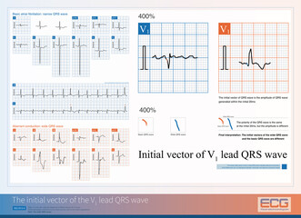 When a wide QRS wave occurs, the same initial vector of the V1 lead QRS wave indicates aberrant conduction, while differences cannot distinguish between ventricular and aberrant conduction beats.