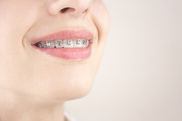 Portrait of a young girl with braces. Orthodontics, dentistry.