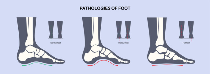 Foot pathologies poster