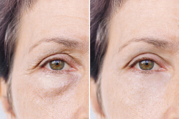 Elderly caucasian woman's face with puffiness under her eyes and wrinkles before and after treatment. Age-related skin changes, fatigue. Result of blepharoplasty plastic surgery.Rejuvenation procedure - obrazy, fototapety, plakaty