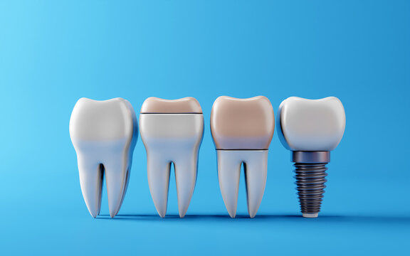 teeth with different types of dental filling with Dental teeth implants, Oral health and dental inspection teeth. Medical dentist tool, children healthcare, 3D render