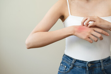 Dermatology, asian young woman reaction from atopic, insect bites on her arm, hand in scratching...