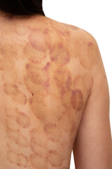 Young woman with hematoma after a session of vacuum cans isolated on white background. Back...