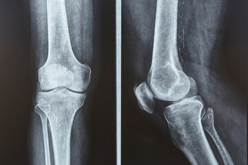 Knee xray. Knee xray. Front and lateral view. Healthcare. Examination