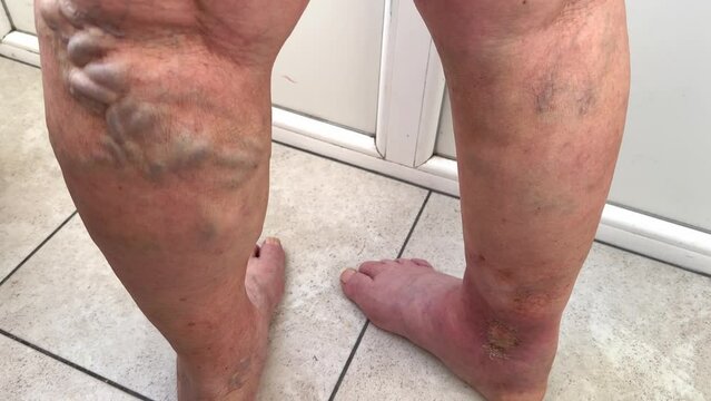 Varicose veins, trophic ulcer, venous disease