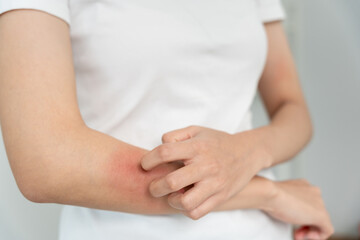 Fototapeta na wymiar skin problem and beauty. Young woman scratch body has itchy skin from skin allergic, steroid allergy, sensitive skin, red from sunburn, chemical allergy, rash, insect bites, Seborrheic Dermatitis.
