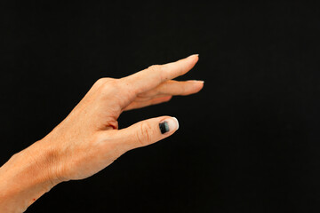 Subungual hematoma present under the toenail of the hallux, more commonly known as the nail broken...