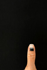 Subungual hematoma present under the toenail of the hallux, more commonly known as the nail broken...