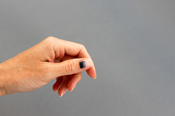 Subungual hematoma present under the toenail of the hallux, more commonly known as the nail broken...