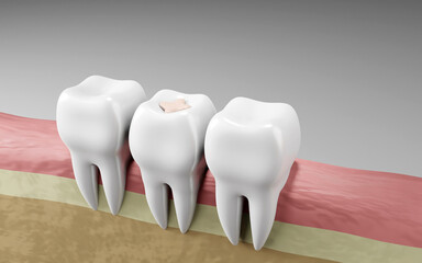 teeth inlays dental filling, Oral health and dental inspection teeth. Medical dentist tool, children healthcare, 3D render