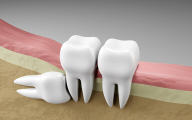 Wisdom tooth impaction. Oral health and dental inspection teeth. Medical dentist tool, children healthcare, 3D render
