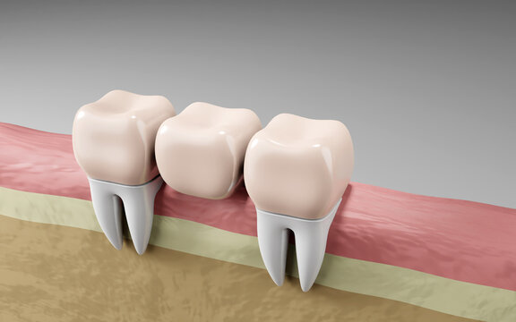 Dental bridge teeth crowns dental filling. Oral health and dental inspection teeth. Medical dentist tool, children healthcare, 3D render