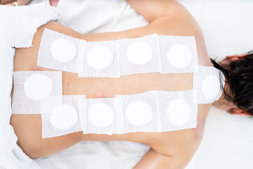 Top view of patient back, disinfected and protected with sticking plasters after hijama treatment.