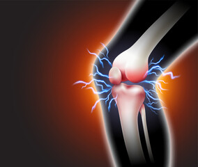 Knee pain and pain throbbing into the bone Inflammatory disease of the knee joint on black background. Realistic 3d vector file. - obrazy, fototapety, plakaty