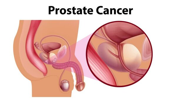 Animation showing human male prostate cancer anatomy in white and green screen background.