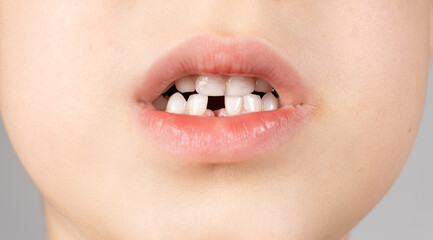 Loss of milk teeth in children. A six-year-old child shows the first baby tooth that has fallen out
