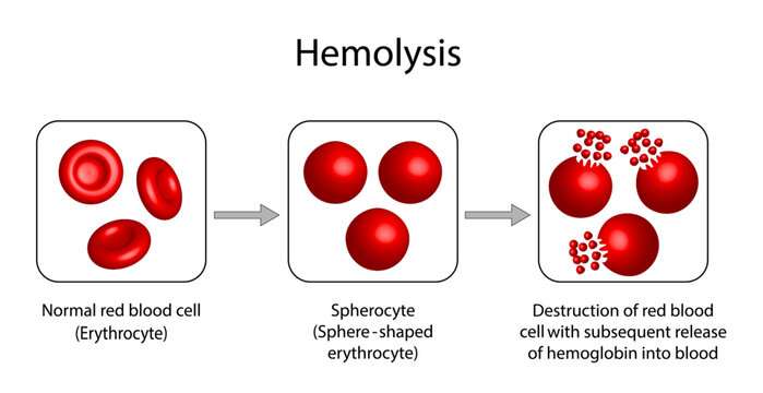 Hemolysis. Normal red blood cell, spherocyte, then destruction of red blood cell with subsequent release of hemoglobin into blood. Vector illustration