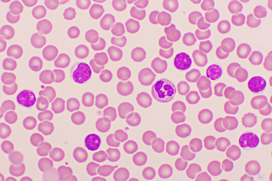 Blood picture of chronic lymphocytic leukemia or CLL, analyze by microscope