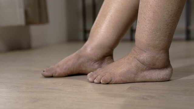 Cancer chemotherapy cause swelling of ankles (ankle oedema) , . skin to become dry, dark or peel and nails brittle or flaky.