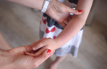 Sunburn redness and peeling of skin on child hand. Baby sunburn and allergy concept
