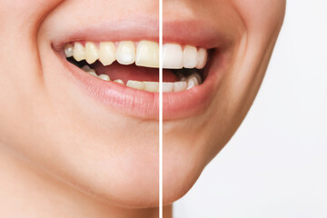 Cropped shot of a young smiling woman before and after teeth whitening isolated on a white background. Dark tooth enamel, contrast. Dentistry, dental care. Difference, comparison. Close up