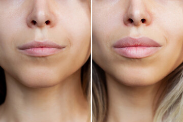 Result of lip augmentation. Cropped shot of young blonde woman's lower part of face with lips before and after lip enhancement. Injection of filler in lips. Difference, comparison - obrazy, fototapety, plakaty