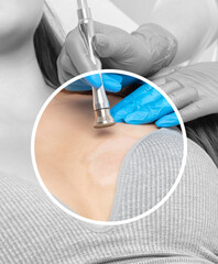 The cosmetologist makes a microdermabrasion procedure on the skin of the chest after a burn of a young woman in a beauty salon. Cosmetology and professional skin care.