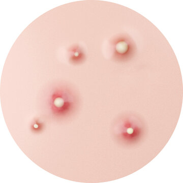 Acne whiteheads 3D rendering.