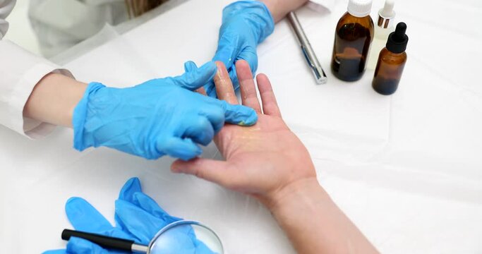 Doctor applies healing ointment to treat patient hand. Skin peeling and burns