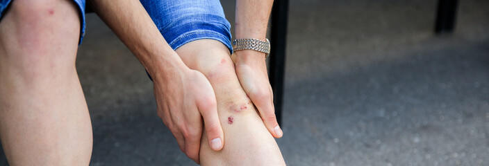 man leg wound