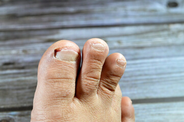 Bleeding of the big toe of the right foot, insult of the foot toe resulting in a bleeding wound...