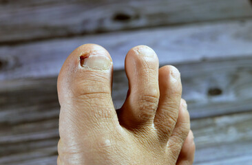 Bleeding of the big toe of the right foot, insult of the foot toe resulting in a bleeding wound...