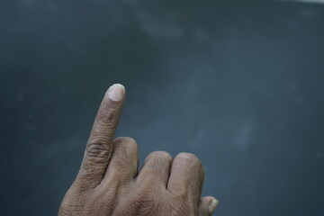 finger nail psoriasis , pinky finger fungus disease
