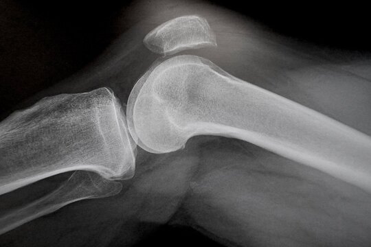 X-ray image of a human knee 
