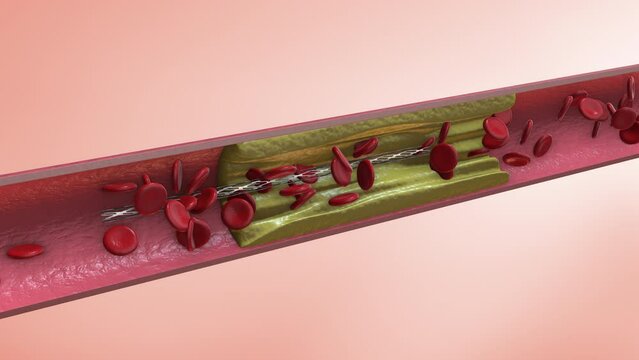 Insertion of a coronary angioplasty stent