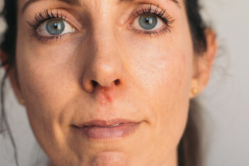 Fototapeta premium Portrait of woman looking straight ahead with herpes sore under nose