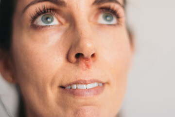 Portrait woman with herpes zoster under the nose looking up, blue eyes