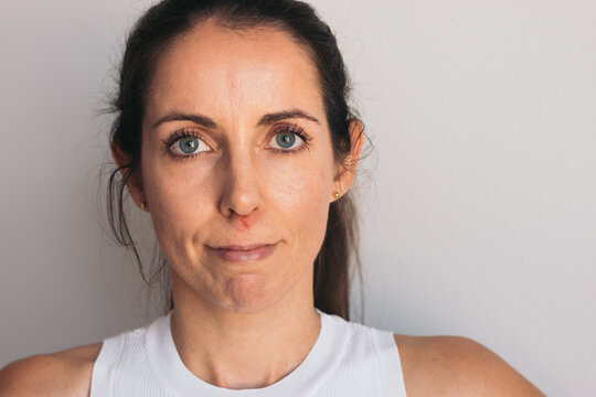 Portrait of woman looking straight ahead with herpes sore under nose