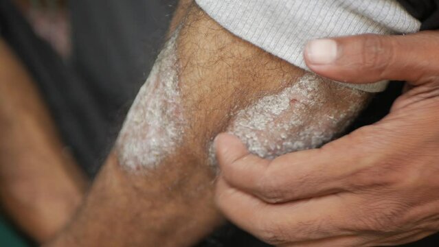 Psoriasis patient scratching the leg ,skin diseases - psoriasis , eczema, dermatitis.