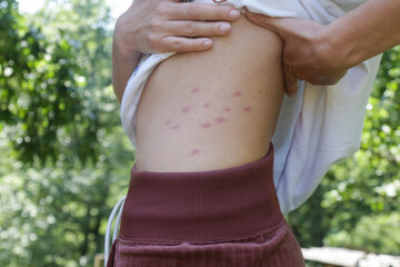 Red, swollen and itchy spots on skin caused by insect bites or allergy. Skin reaction to insect...