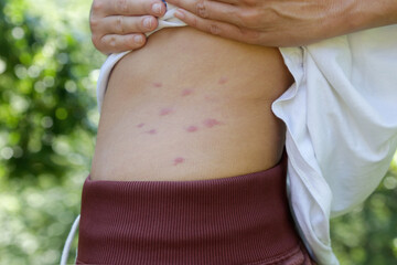 Red, swollen and itchy spots on skin caused by insect bites or allergy. Skin reaction to insect bites.