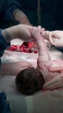 Vertical video. The child is born by caesarean section. A newborn baby seconds and minutes after birth. The doctor rubs the baby's back. Obstetricians apply clamps so that the surgeon sews up the
