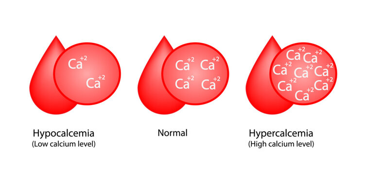 Hypercalcemia, high plasma calcium level and hypocalcemia, low plasma calcium level. Calcium excess and deficit electrolyte disorders, blood droplet, Scientific design. Vector illustration.