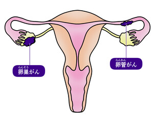 卵巣がんと卵管がんのシンプルなイラスト © Nenta