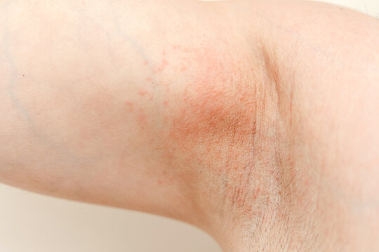 Allergy underarm. Cropped photo of irritation, inflammation on the sensitive skin after using a razor, trimmer, toxic deodorant or antiperspirant. Armpit rash. Atopic dermatitis. Acne or red spots.